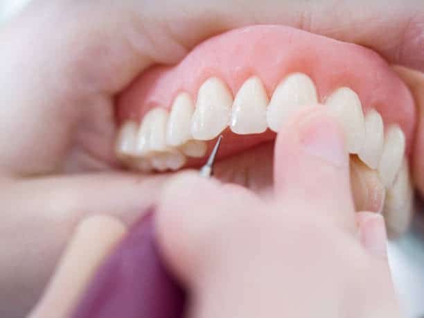Anni di Problemi Dentali, Un Piano Completo: La Potenza degli Impianti Dentali Full-Mouth