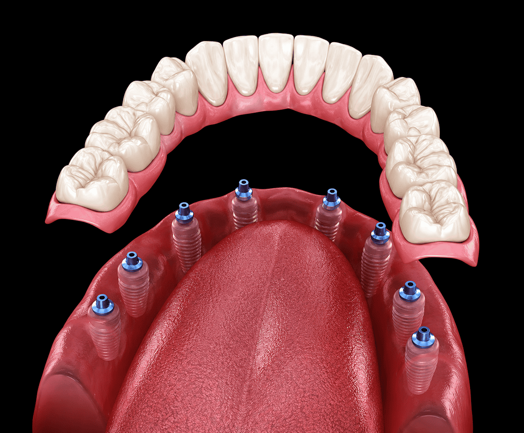 Protesi dentali su impianti con impianti multipli e denti artificiali su sfondo nero.