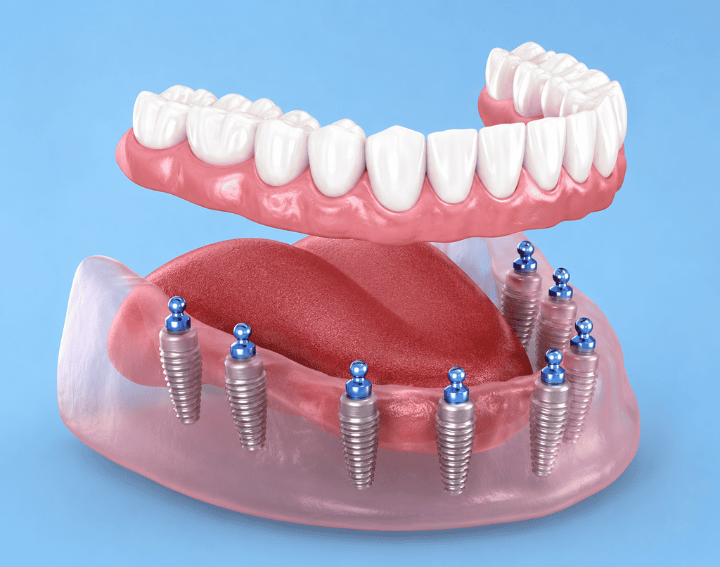 Modello di impianto dentale che mostra più impianti e una protesi dentaria superiore completa.