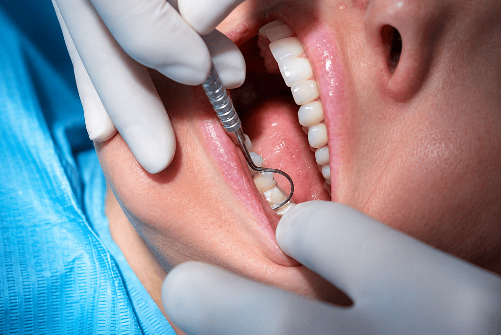 Close-up of a dental procedure with a dentist using a mirror and scaler on a patient's teeth.