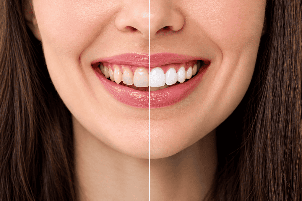 Before and after teeth whitening showing a bright, healthy smile.