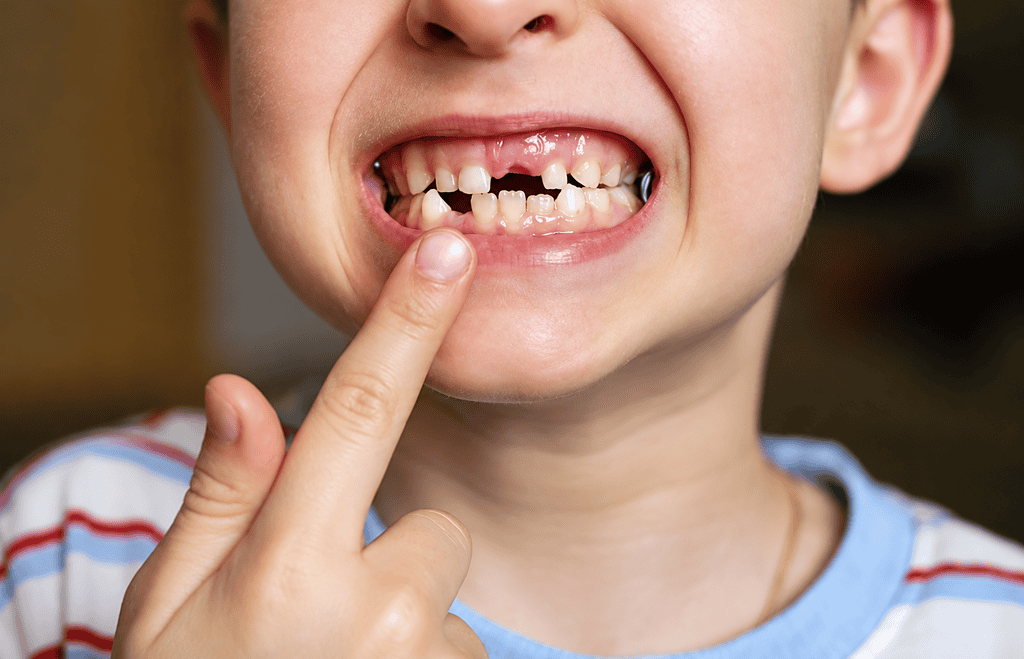 Child showing missing and decayed teeth in close-up.