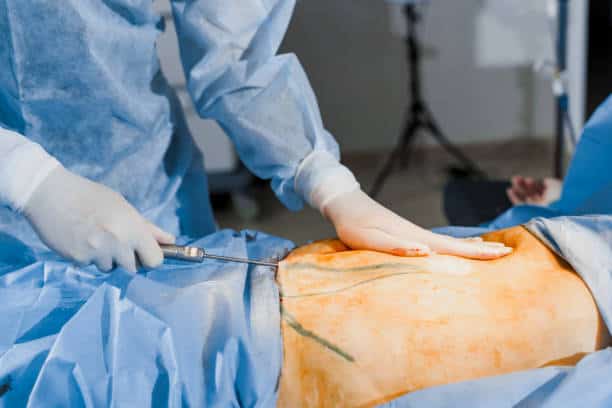 360 Liposuction in Albania