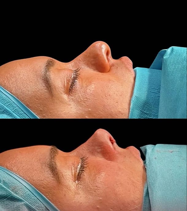 Amazing results before and after rhinoplasty in Albania