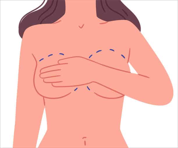 Breast Lift (Mastopexy) In Albania