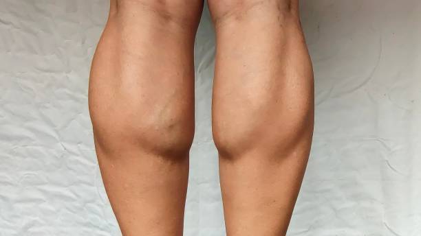 Calf Augmentation In Albania