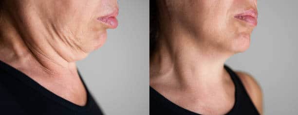 Candidates For Neck Lift
