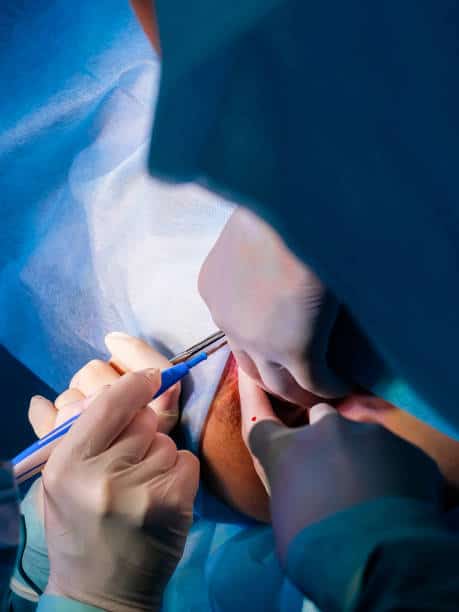 Different Labiaplasty Techniques