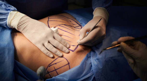 Extended Tummy Tuck Procedure