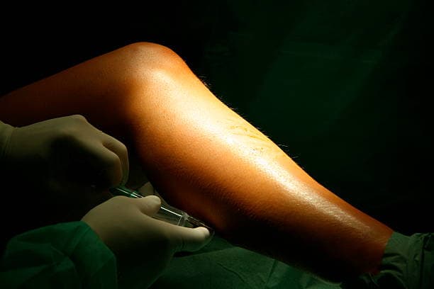 Final Calf Augmentation Results