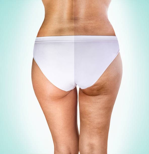 Good Candidate For Cellulite Treatment