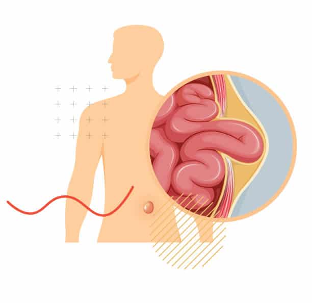 Hernia Surgery in Albania