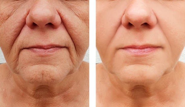 Ideal Candidates for Deep Plane Facelift