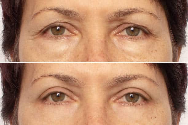 Ideal Candidates for Eyelid Surgery