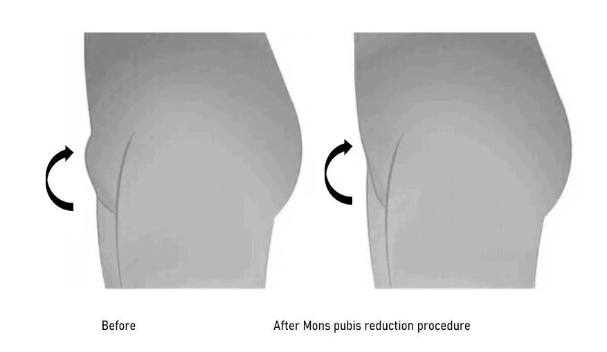 Mons pubis reduction in Albania, Tirana