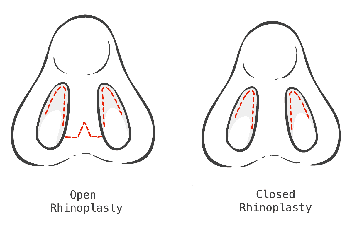 Open vs. Closed Rhinoplasty Techniques
