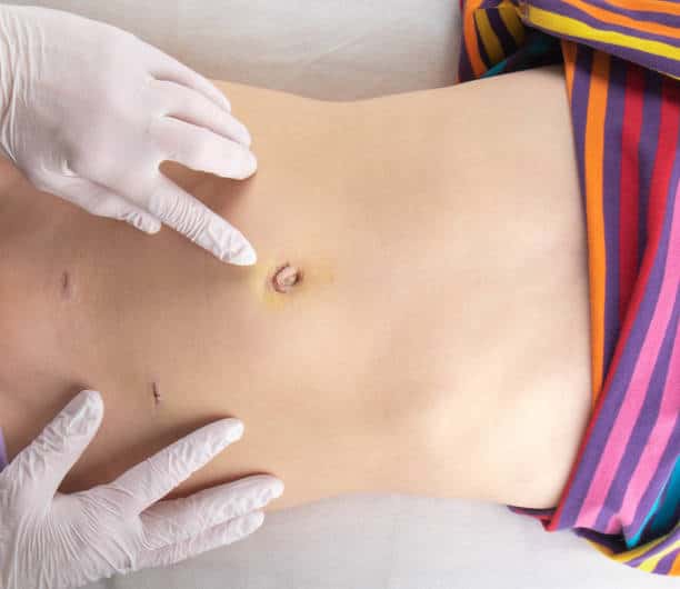 Procedure of Umbilicoplasty