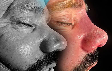 results before and after male rhinoplasty in Albania