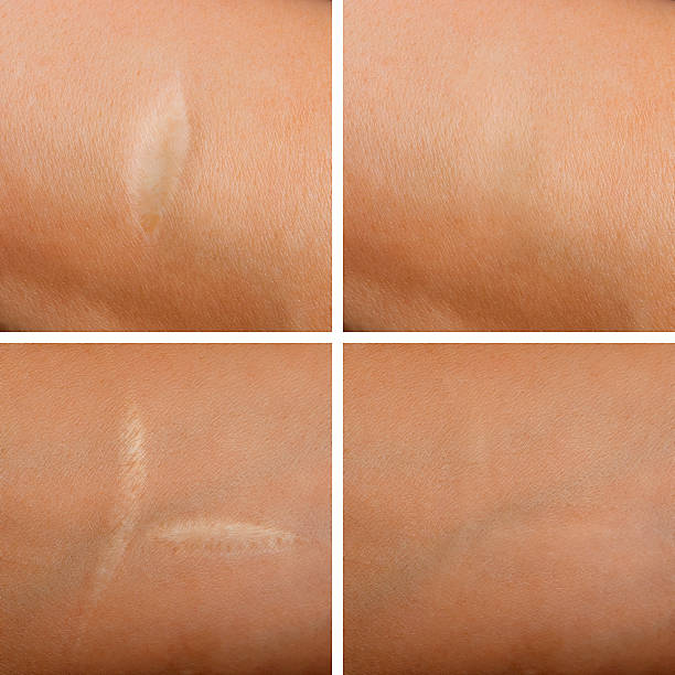 Scar Revision In Albania