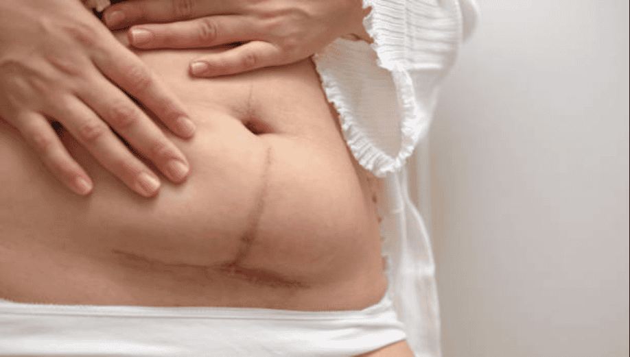 post-pregnancy plastic surgery in Albania