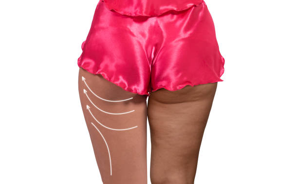 Thigh Lift In Albania American Hospital