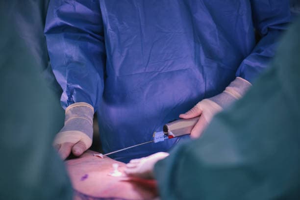 VASER Liposuction procedure