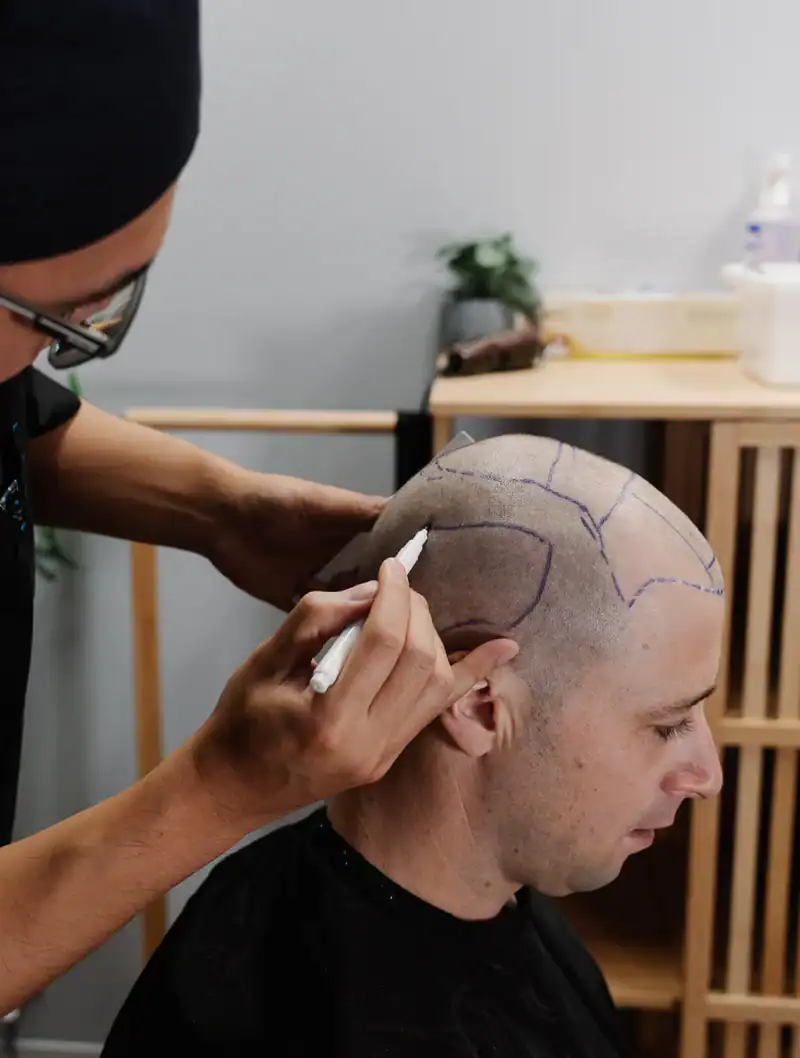 Why Albania for Hair Transplant