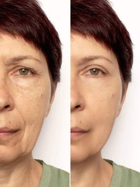 Why People Choose Deep Plane Facelift