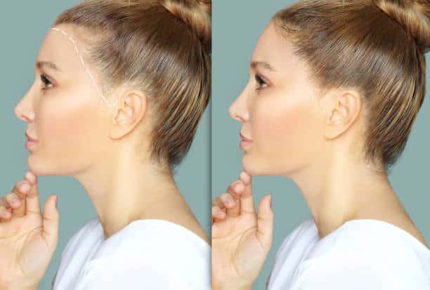 Why People Choose Forehead Reduction