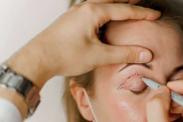 Woman marked for eyelid surgery