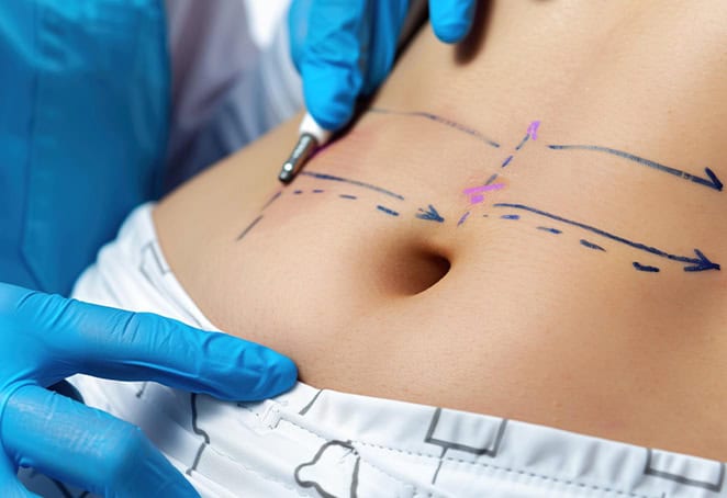 affordable abdominplasty in Albania