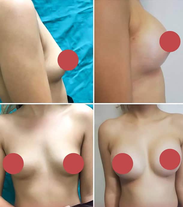 affordable breast augmentation in Albania