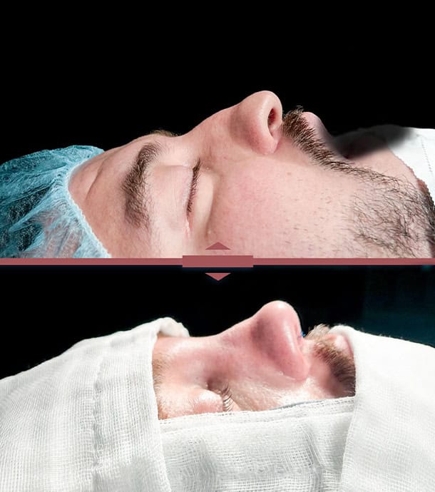 affordable male rhinoplasty in Albania