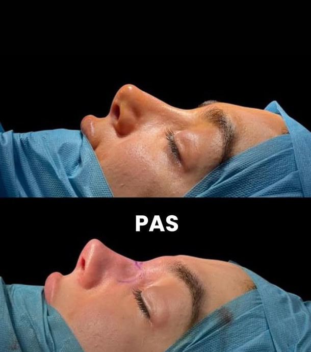 affordable nose surgery in Albania