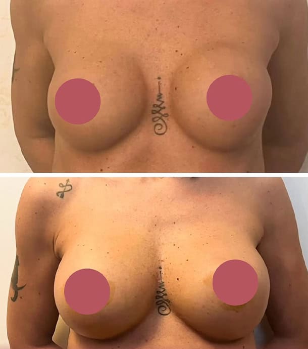 amazing before and after breast augmentation in Albania results