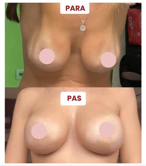 amazing before and after breast lift in Albania