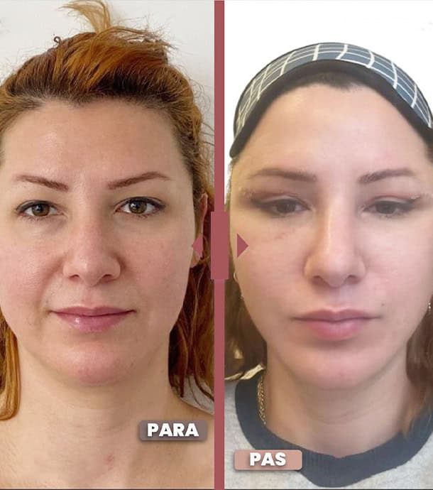 amazing before and after face lift in Albania
