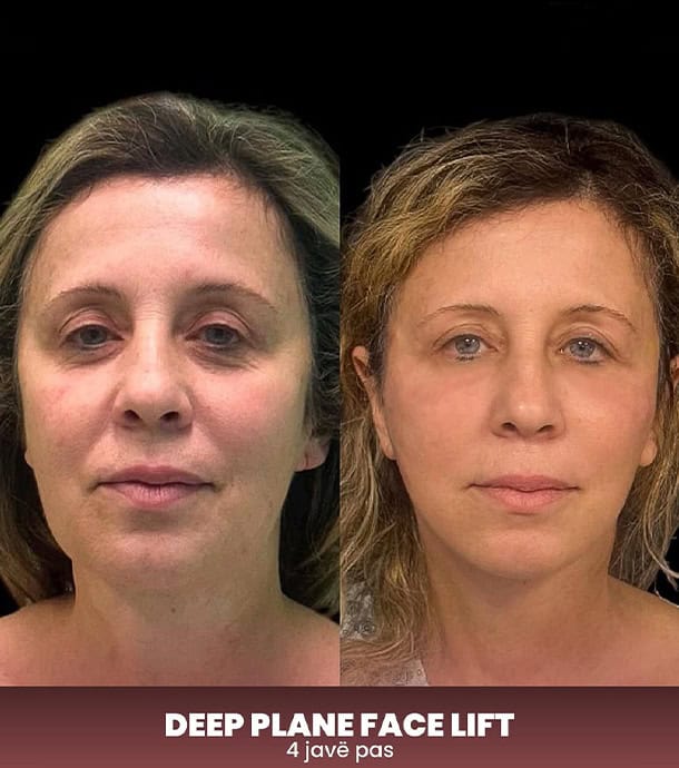 amazing before and after face lift surgery in Albania