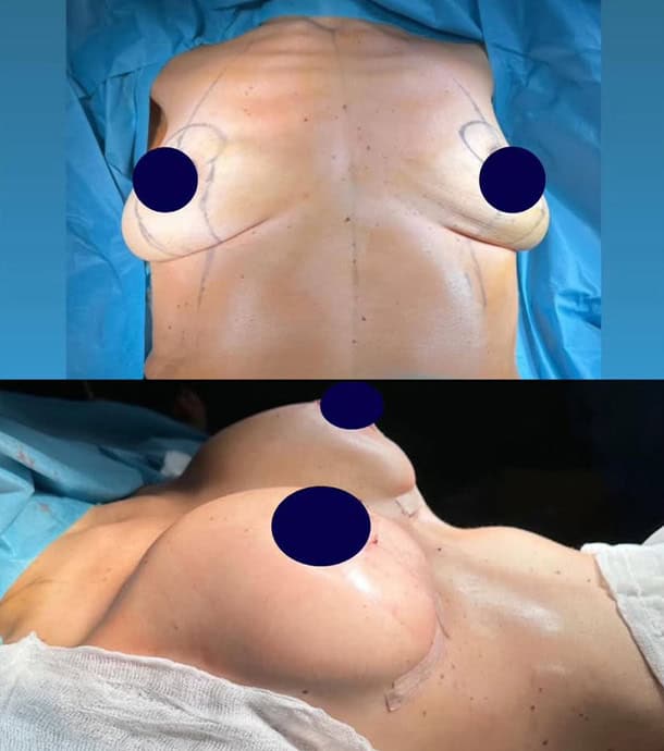 amazing results after breast augmentation in Albania