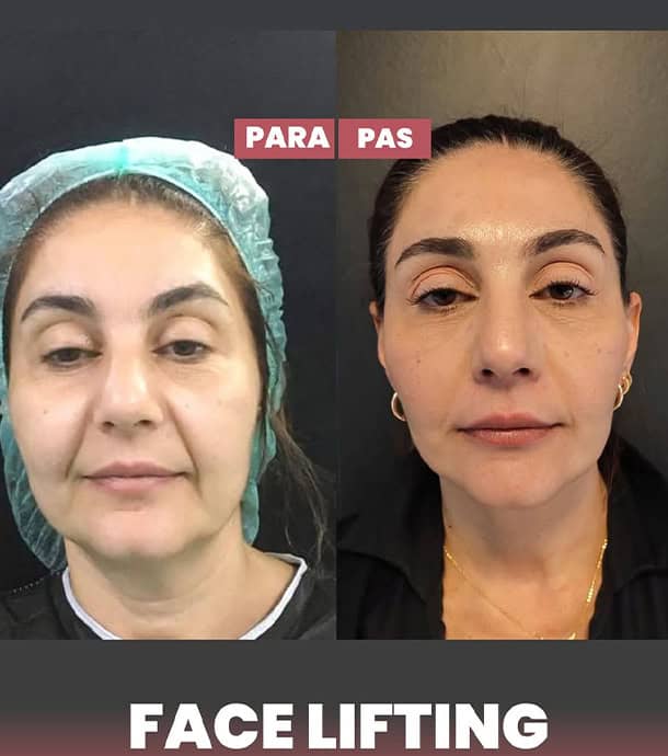 amazing results after face lift in Albania