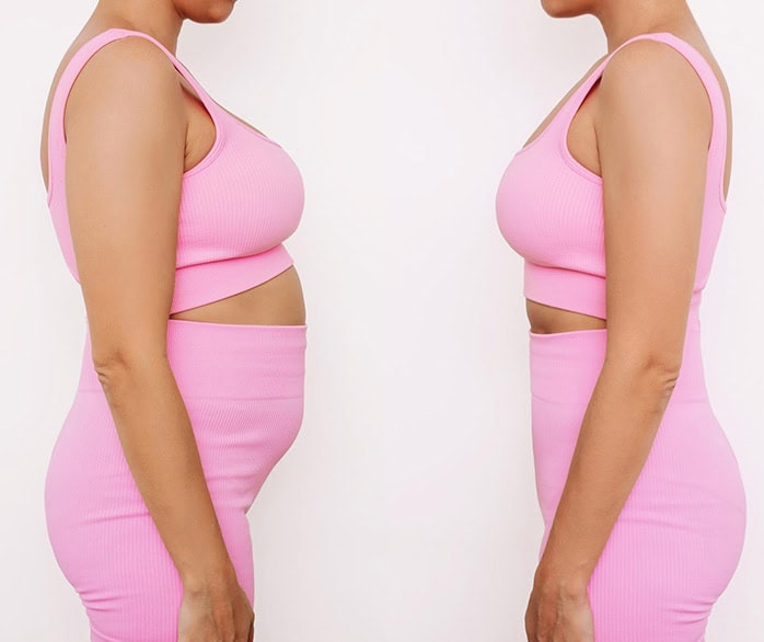 amazing results before and after abdominoplasty in Albania