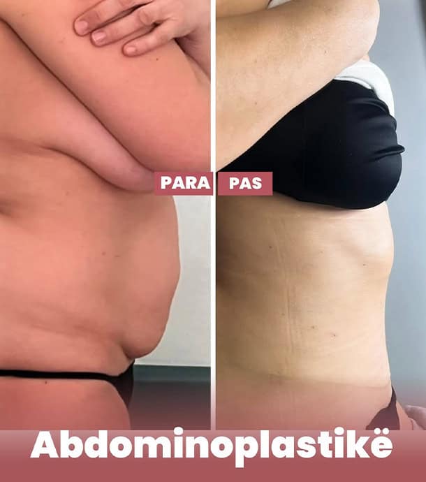amazing results before and after abdominoplasty in Albania