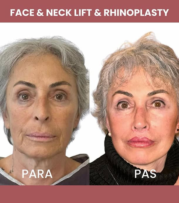 amazing results before and after face lift in Albania