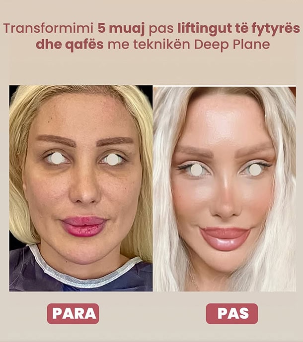 amazing results before and after face lift surgery in Albania
