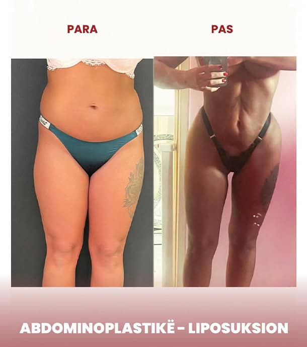amazing results before and after liposuction and abdominoplasty in Albania
