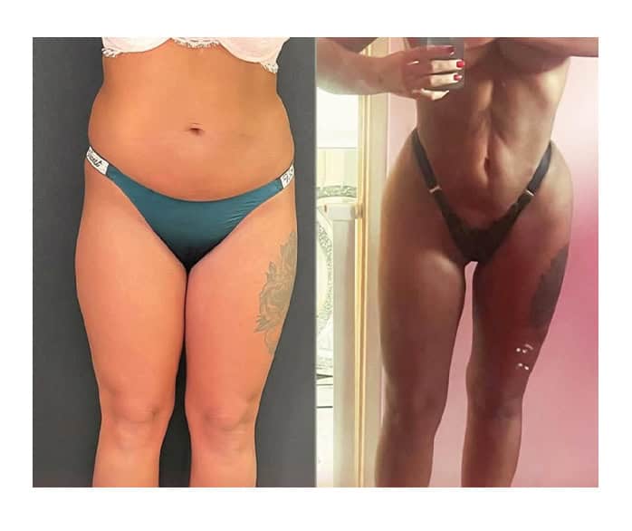 amazing results before and after liposuction in Albania