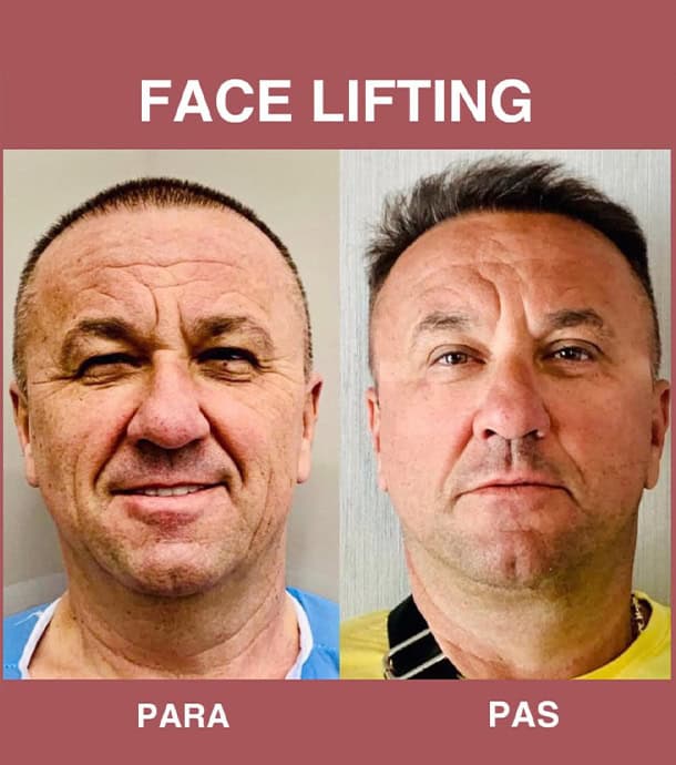 amazing results before and after male face lift in Albania