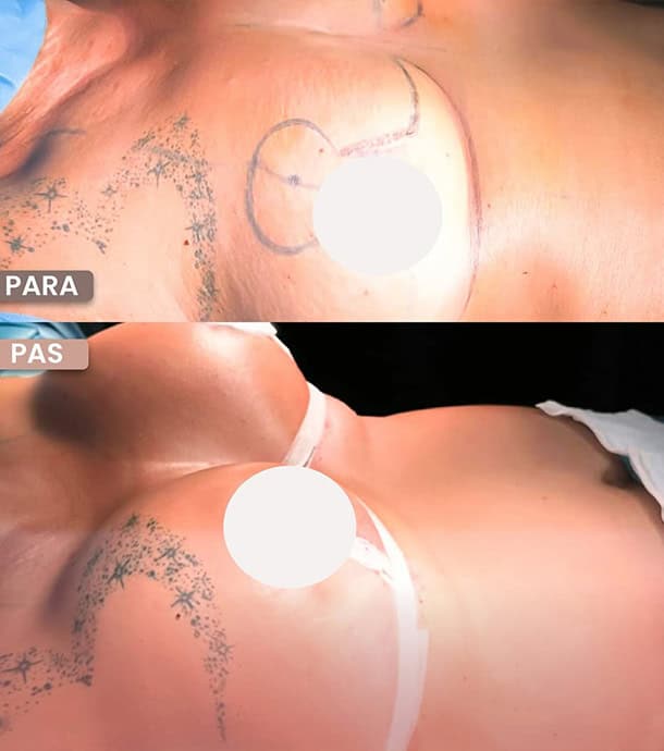 amazing results before and after mastopexy in Albania