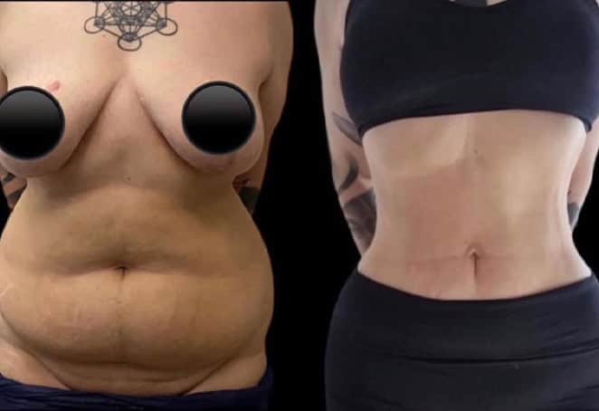 amazing results before and after mommy makeover in Albania