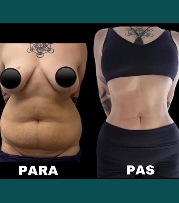 amazing results before and after mommy makeover in Albania